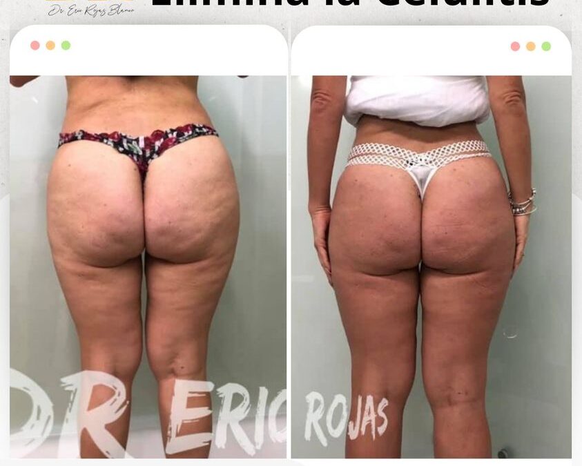 Contamos con la mejor herramienta para eliminar la celulitis.