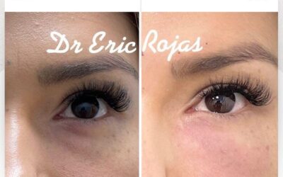 Adiós Ojeras, las mejores técnicas.