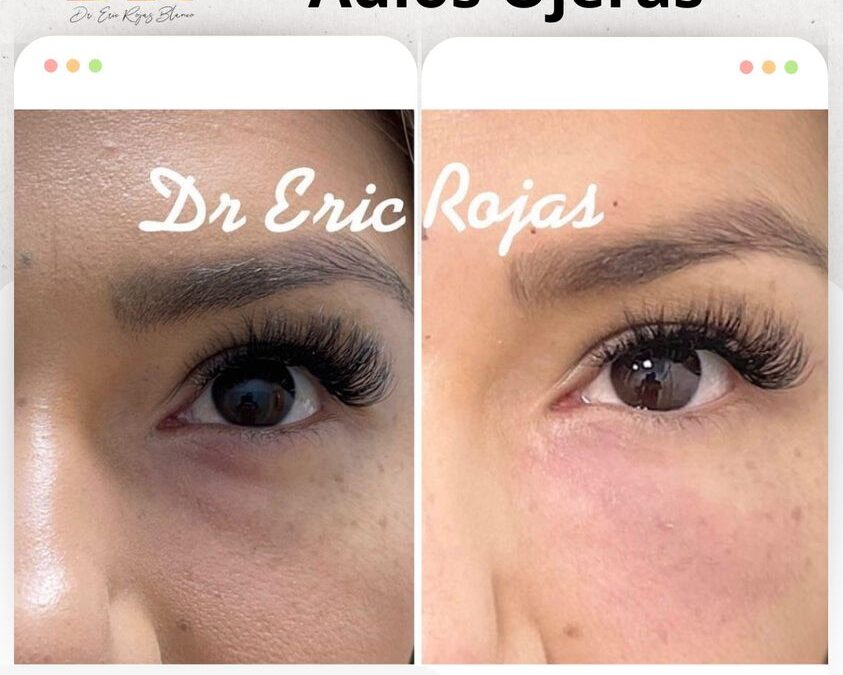 Adiós Ojeras, las mejores técnicas.