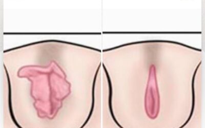 Dermo-labioplastía en solo $799 dólares, te ayudamos a que elimines tus complejos.