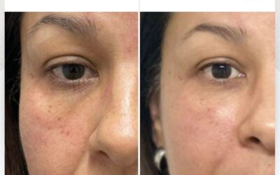 Rejuvenece tu rostro con la mejor técnica.