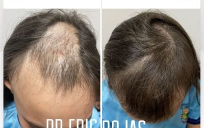 Caída de cabello con la mejor técnica del país.