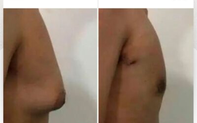 Ginecomastia, elimina los complejos