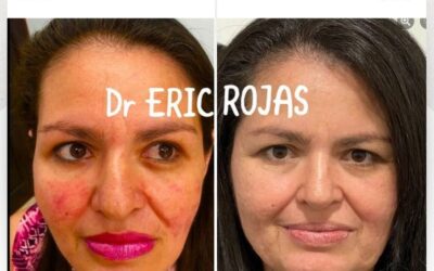 La rosacea si se cura.