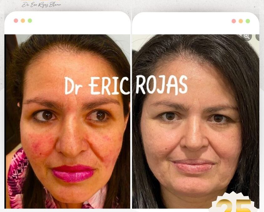 La rosacea si se cura.