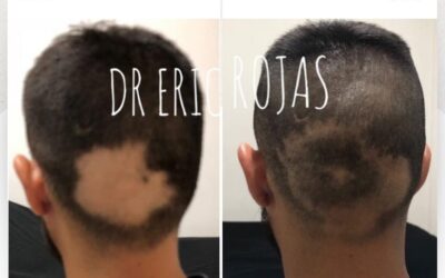 Recupera tu cabello