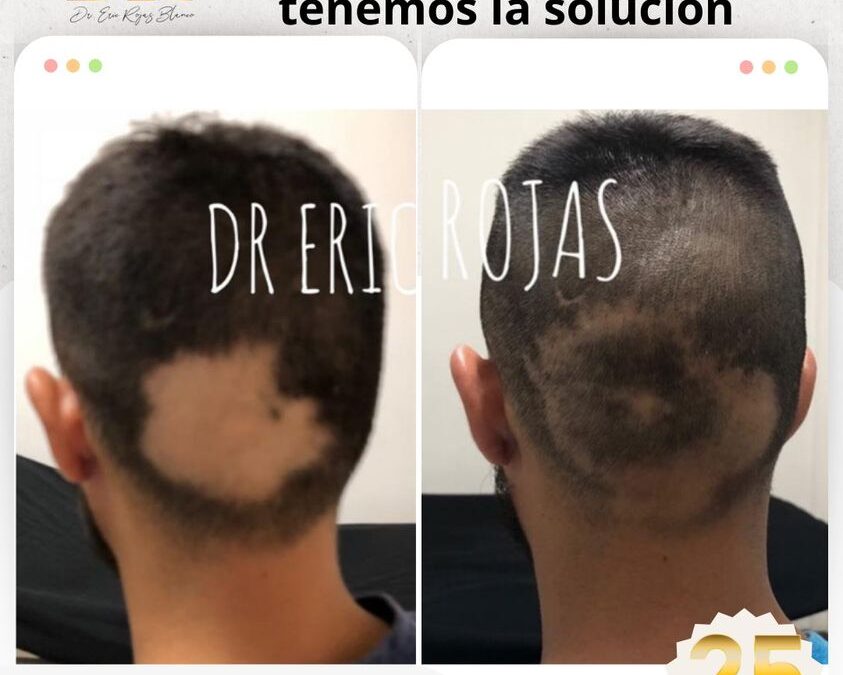 Recupera tu cabello