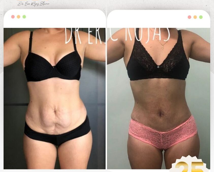 Slim Laser abdomen