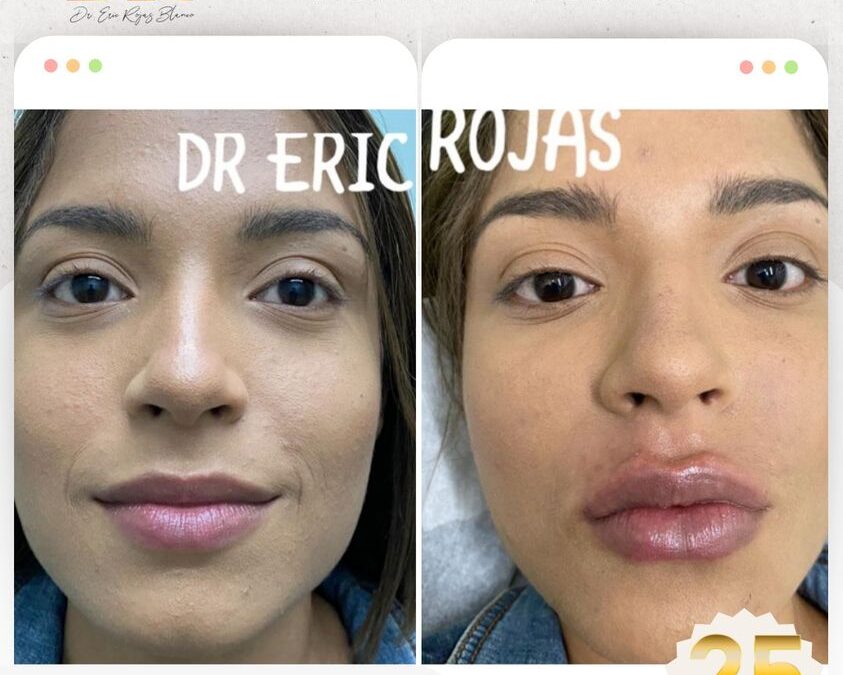 Relleno de labios.