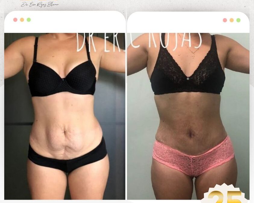 Slim láser abdomen