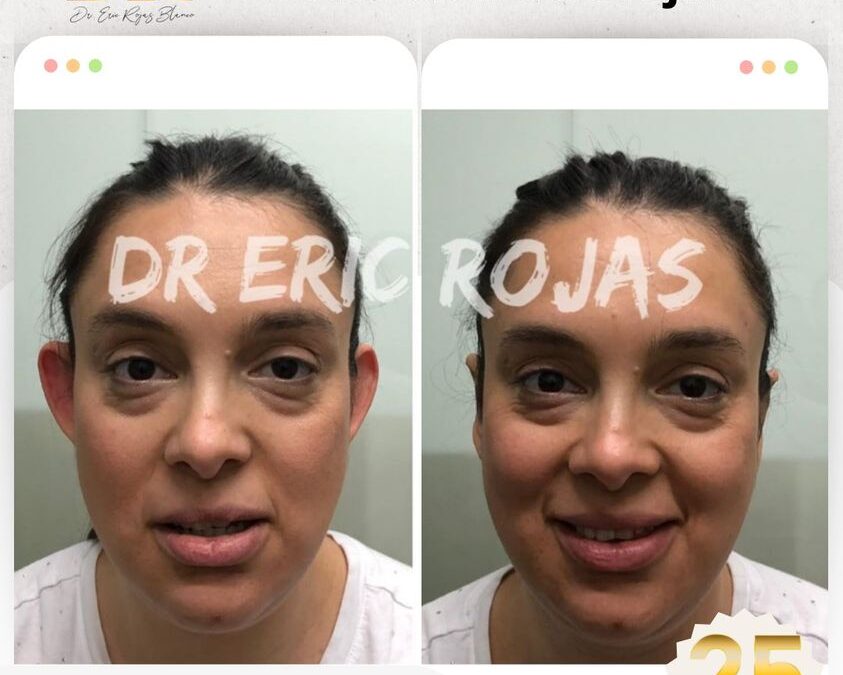 Corrección de orejas con la Dermo Otoplastía.
