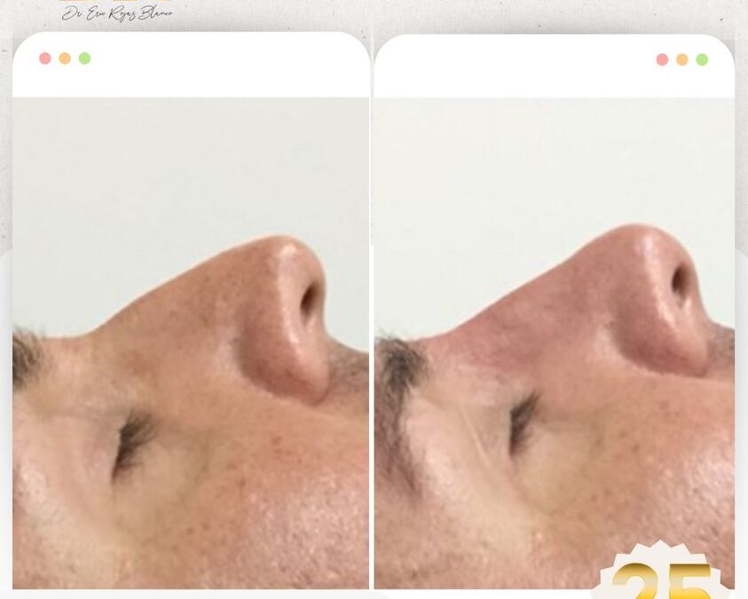 Correción de Nariz con Rinolift