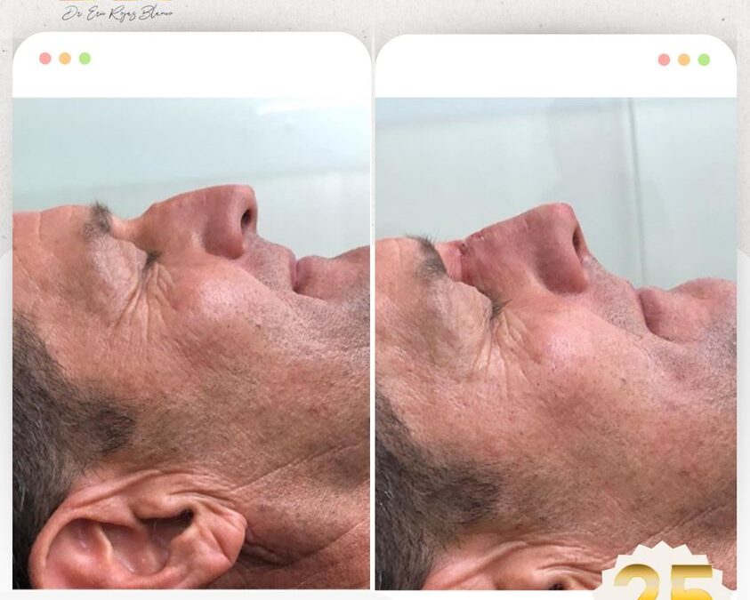 Corrección de nariz con Rinolift