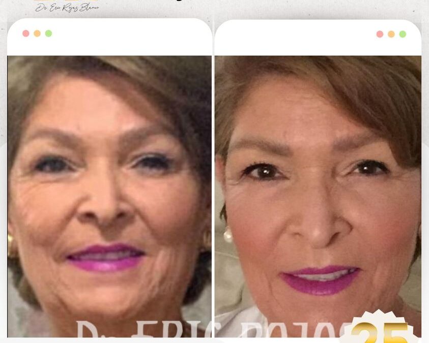 Rejuvenecimiento con la mejor técnica.