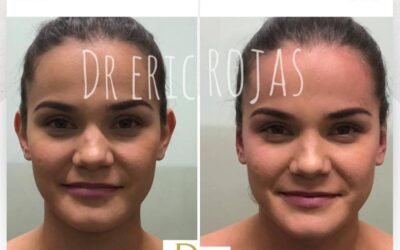 Corrección de orejas con dermo otoplastía.