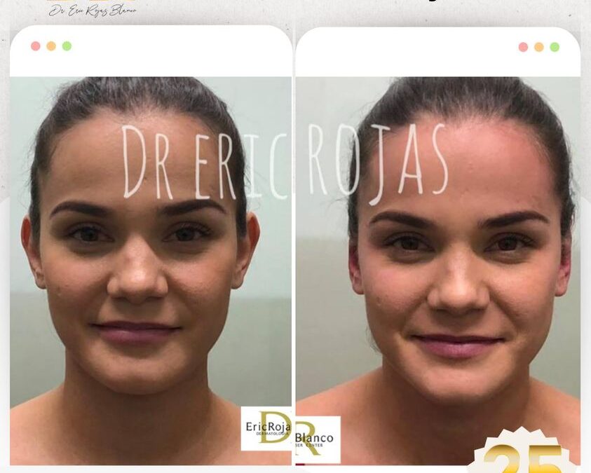Corrección de orejas con dermo otoplastía.