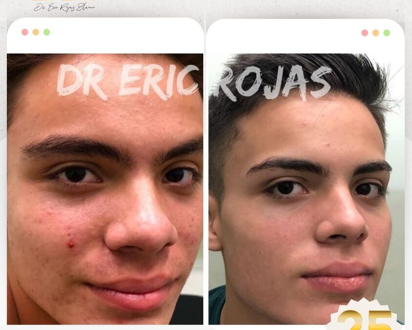 Elimina el acné de tu vida con el mejor tratamiento