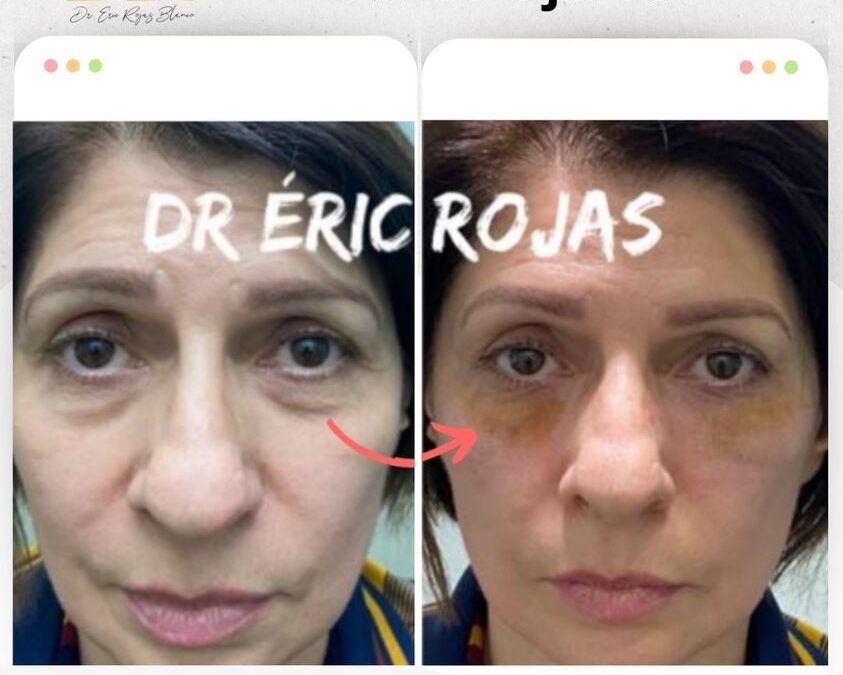 Elimina las Ojeras y luce renovada/o