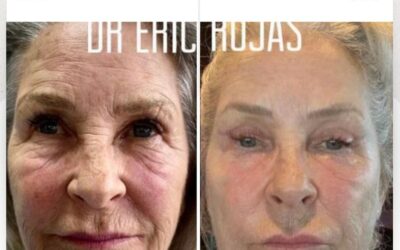 Rejuvenecimiento Facial, la mejor técnica del país.