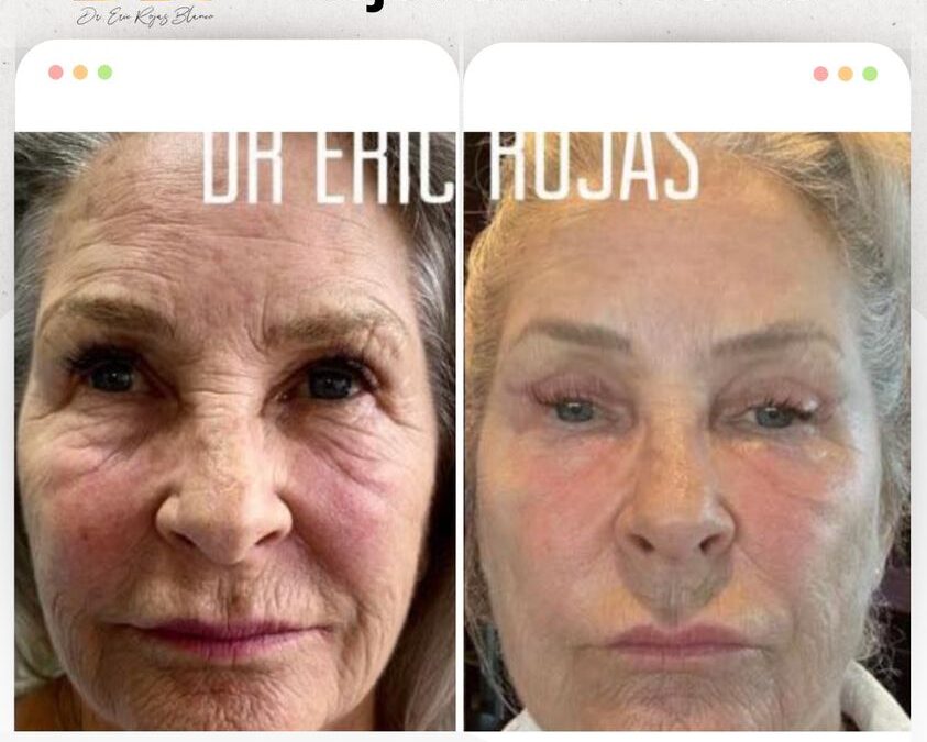 Rejuvenecimiento Facial, la mejor técnica del país.