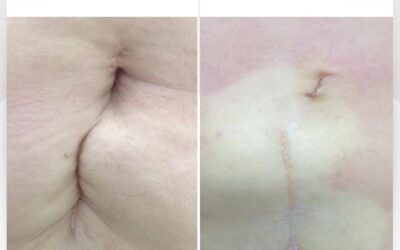 Esa cicatriz que dejo tu cesárea o cirugía que divide tu abdomen ya puedes mejorarla con nosotros, Slim Láser lo logra.