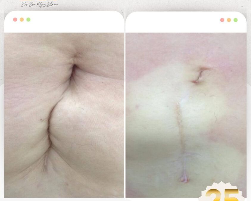 Esa cicatriz que dejo tu cesárea o cirugía que divide tu abdomen ya puedes mejorarla con nosotros, Slim Láser lo logra.