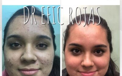 Limpia tu rostro con el mejor tratamiento de acné.