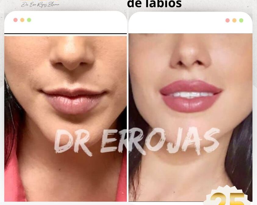 Relleno y moldeado de labios en promoción.