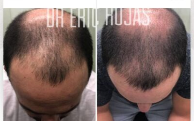 Recupera tu cabello con la mejor oferta