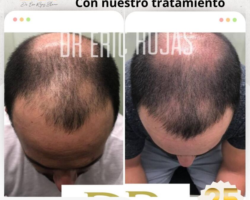 Recupera tu cabello con la mejor oferta