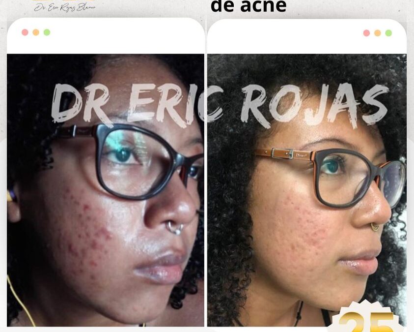 Elimina el acné de tu vida y vive feliz.