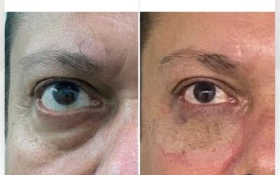 Elimina tus ojeras de una vez por todas. 🤩