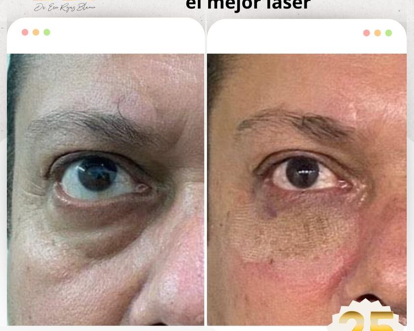 Elimina tus ojeras de una vez por todas. 🤩