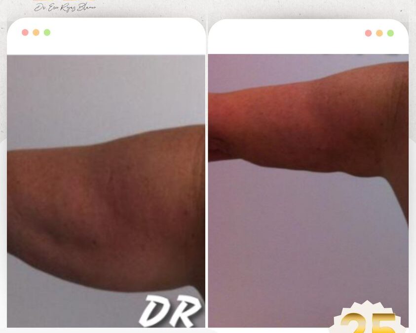 Slim Láser brazos, ¿Qué te parecen estos resultados? 🤩