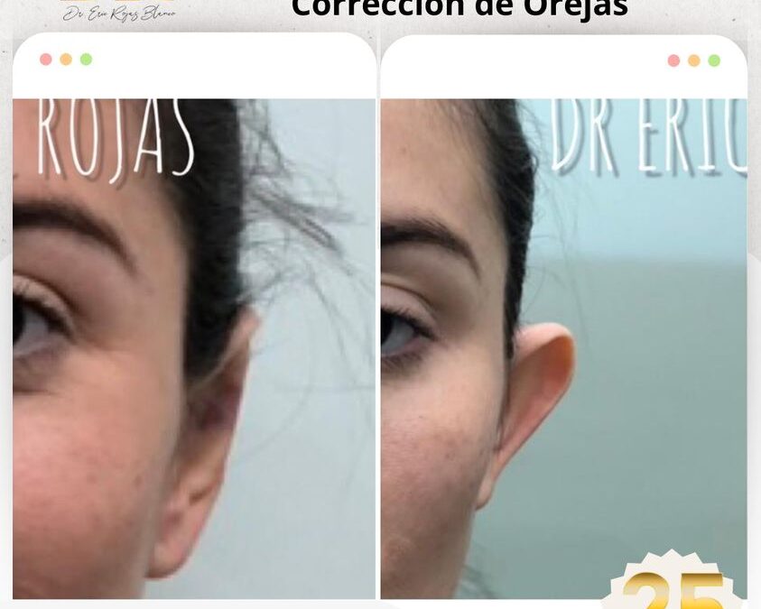 Corrección de orejas, ¡En 20 minutos!