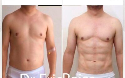 Marcaje abdominal con Slim Láser.