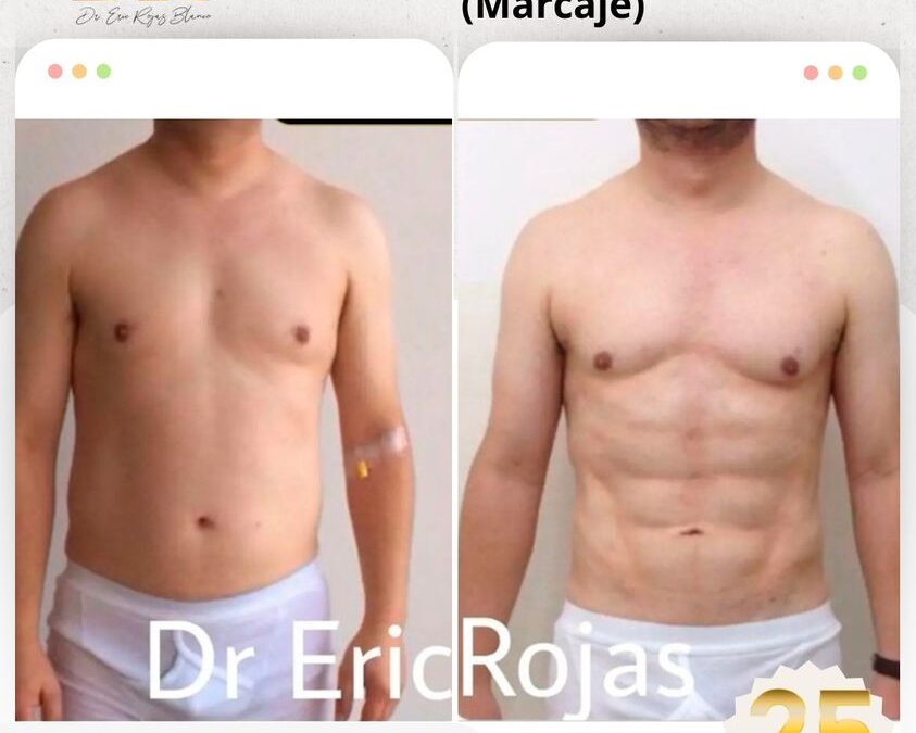 Marcaje abdominal con Slim Láser.