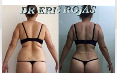 Slim Láser, los mejores resultados con el mejor procedimiento.