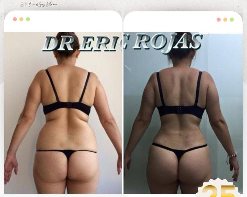 Slim Láser, los mejores resultados con el mejor procedimiento.