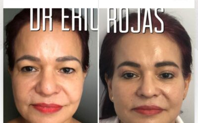 Corrección de orejas con Dermo Otoplastía.