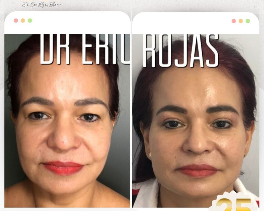 Corrección de orejas con Dermo Otoplastía.