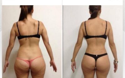 Slim Láser es la mejor técnica y tecnología para moldear tu cuerpo