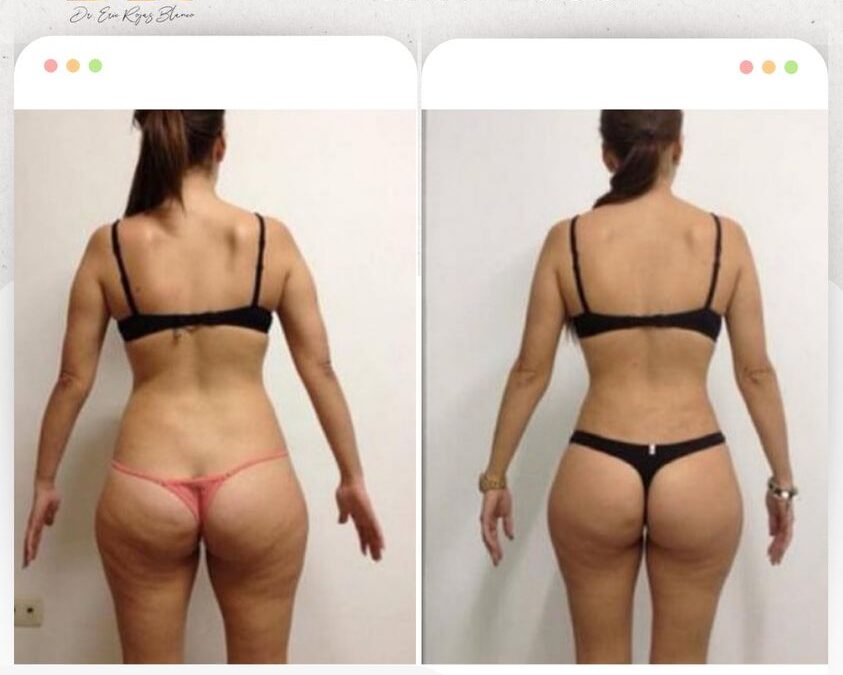 Slim Láser es la mejor técnica y tecnología para moldear tu cuerpo