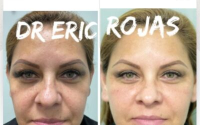 Rejuvenece tu rostro con la mejor técnica.