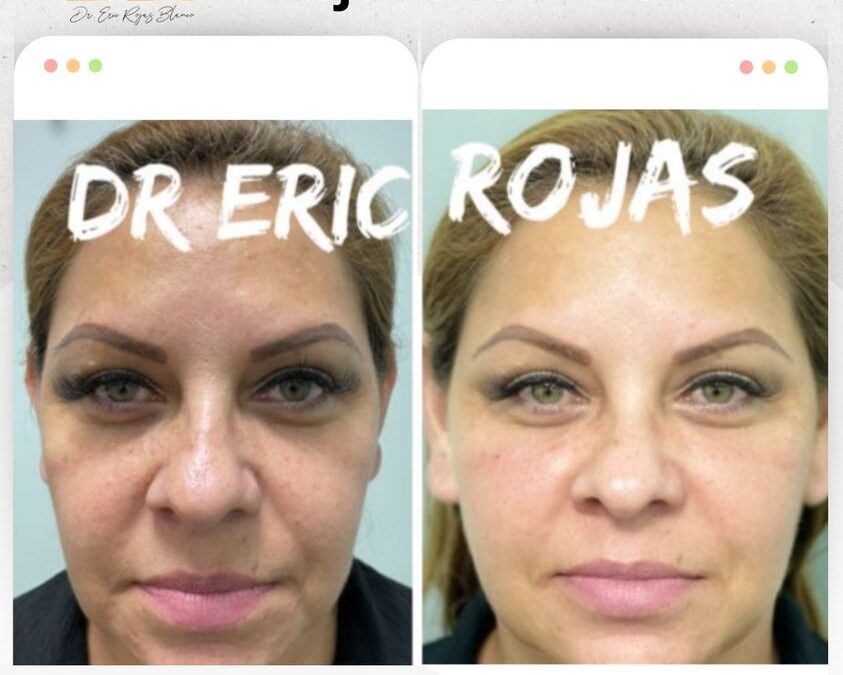 Rejuvenece tu rostro con la mejor técnica.