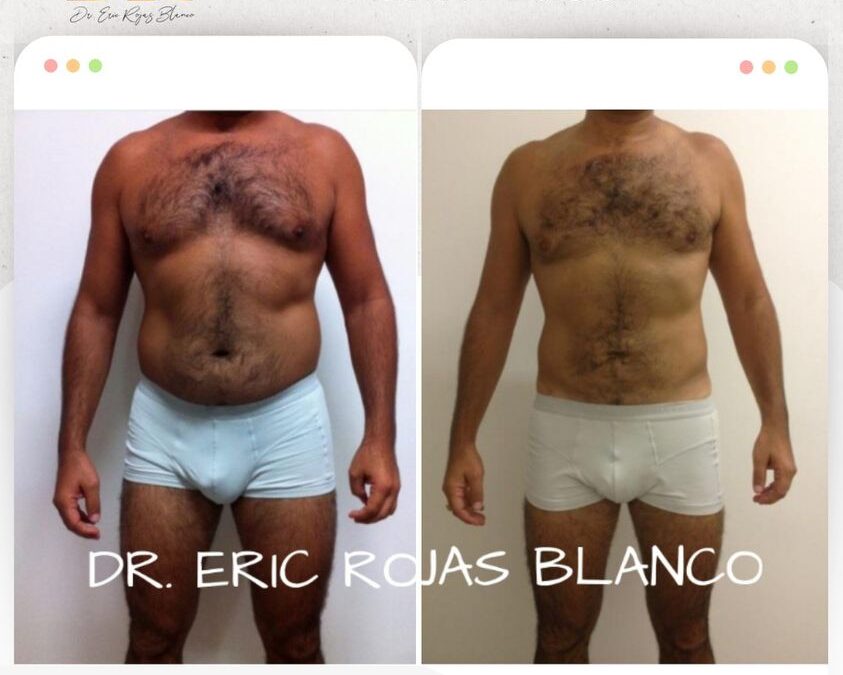 El Slim Láser genera estos increíbles cambios.