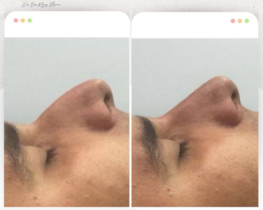 Rinolift es el mejor procedimiento para mejorar el perfil de tu nariz.