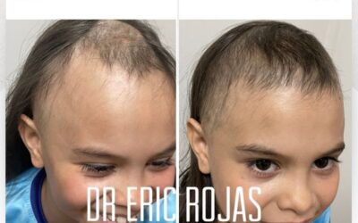 Alopecia en niños, también lo tratamos.