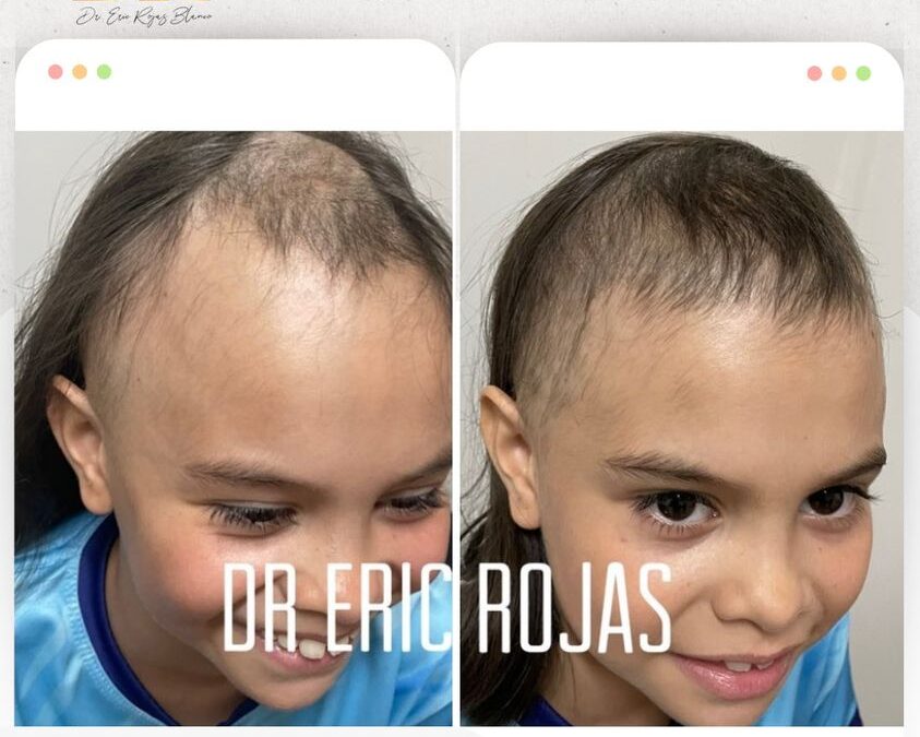 Alopecia en niños, también lo tratamos.