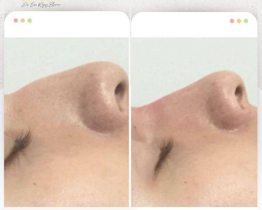 Rinolift es el procedimiento ideal para mejorar el perfil de tu nariz.